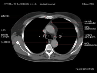 T esternón v.c.s. cayado v. ácigos v. ácigos espacio prevascular aorta  ascendente ventana aorto-pulm. aorta descendente TC axial con contraste CATEDRA  DE  RADIOLOGIA  U.N.L.P.   Mediastino normal  Edición  2004 