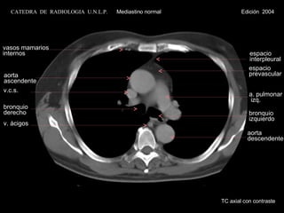 aorta ascendente v.c.s. v. ácigos espacio prevascular a. pulmonar izq. bronquio derecho bronquio izquierdo aorta descendente espacio interpleural vasos mamarios internos TC axial con contraste CATEDRA  DE  RADIOLOGIA  U.N.L.P.   Mediastino normal  Edición  2004 