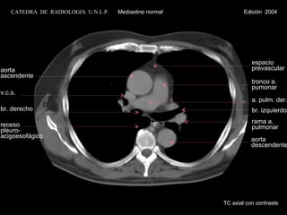 aorta ascendente v.c.s. br. derecho receso pleuro- acigoesofágico rama a. pulmonar tronco a. pumonar a. pulm. der. br. izquierdo aorta descendente espacio prevascular TC axial con contraste E CATEDRA  DE  RADIOLOGIA  U.N.L.P.   Mediastino normal  Edición  2004 