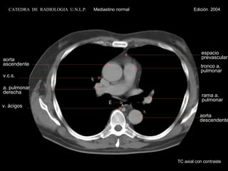 aorta ascendente v.c.s. a. pulmonar derecha espacio prevascular tronco a. pulmonar aorta descendente v. ácigos E rama a. pulmonar TC axial con contraste CATEDRA  DE  RADIOLOGIA  U.N.L.P.   Mediastino normal  Edición  2004 