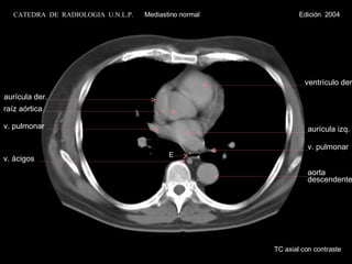 E ventrículo der. aurícula izq. v. pulmonar aurícula der. raíz aórtica v. pulmonar v. ácigos TC axial con contraste aorta descendente CATEDRA  DE  RADIOLOGIA  U.N.L.P.   Mediastino normal  Edición  2004 