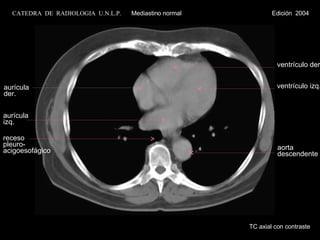 aurícula der. aurícula izq. ventrículo der. ventrículo izq. receso pleuro- acigoesofágico TC axial con contraste aorta descendente CATEDRA  DE  RADIOLOGIA  U.N.L.P.   Mediastino normal  Edición  2004 
