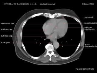 TC axial con contraste ventrículo der. aurícula izq. v. ácigos aurícula der. aorta descendente CATEDRA  DE  RADIOLOGIA  U.N.L.P.   Mediastino normal  Edición  2004 ventrículo izq. tabique interventric. pericardio 