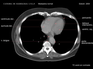 TC axial con contraste E ventrículo der. aurícula der. tabique interventric. ventríc. izq. v. ácigos pericardio aorta descendente CATEDRA  DE  RADIOLOGIA  U.N.L.P.   Mediastino normal  Edición  2004 