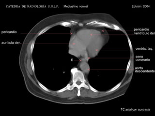 TC axial con contraste aurícula der. ventrículo der. ventríc. izq. E pericardio pericardio aorta descendente seno coronario CATEDRA  DE  RADIOLOGIA  U.N.L.P.   Mediastino normal  Edición  2004 