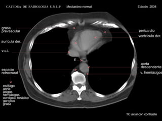 TC axial con contraste E v.c.i. ventrículo der. grasa prevascular pericardio esófago aorta ácigos hemiácigos conducto torácico ganglios grasa espacio  retrocrural aurícula der. aorta descendente v. hemiácigos CATEDRA  DE  RADIOLOGIA  U.N.L.P.   Mediastino normal  Edición  2004 