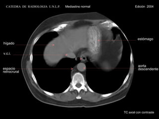TC axial con contraste E hígado v.c.i. estómago espacio retrocrural aorta descendente CATEDRA  DE  RADIOLOGIA  U.N.L.P.   Mediastino normal  Edición  2004 