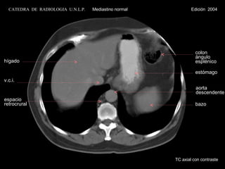 TC axial con contraste hígado v.c.i. espacio retrocrural colon ángulo esplénico estómago bazo aorta descendente CATEDRA  DE  RADIOLOGIA  U.N.L.P.   Mediastino normal  Edición  2004 