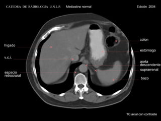 suprarrenal TC axial con contraste hígado v.c.i. espacio retrocrural colon estómago bazo aorta descendente CATEDRA  DE  RADIOLOGIA  U.N.L.P.   Mediastino normal  Edición  2004 