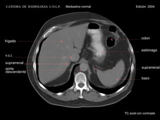 TC axial con contraste hígado v.c.i. suprarrenal bazo suprarrenal estómago colon aorta descendente CATEDRA  DE  RADIOLOGIA  U.N.L.P.   Mediastino normal  Edición  2004 