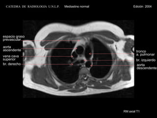 RM axial T1 aorta ascendente vena cava superior br. derecho tronco  a. pulmonar espacio graso prevascular br. izquierdo aorta descendente CATEDRA  DE  RADIOLOGIA  U.N.L.P.   Mediastino normal  Edición  2004 