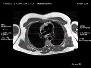 RM axial T1 aorta ascendente v.c.s. v. pulmonar superior. tronco  a.pulmonar a. pulmonar derecha bronquio intermediario aorta descendente CATEDRA  DE  RADIOLOGIA  U.N.L.P.   Mediastino normal  Edición  2004 