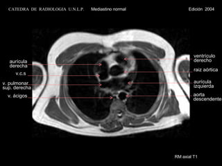 RM axial T1 raiz aórtica ventrículo derecho v.c.s aurícula derecha aurícula  izquierda v. pulmonar  sup. derecha v. ácigos aorta descendente CATEDRA  DE  RADIOLOGIA  U.N.L.P.   Mediastino normal  Edición  2004 