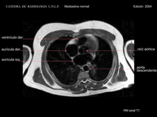 RM axial T1 aurícula der. aurícula izq. ventrículo der. raíz aórtica aorta descendente CATEDRA  DE  RADIOLOGIA  U.N.L.P.   Mediastino normal  Edición  2004 