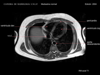 RM axial T1 pericardio ventrículo izq. ventrículo der. v.c.i. aorta descendente CATEDRA  DE  RADIOLOGIA  U.N.L.P.   Mediastino normal  Edición  2004 