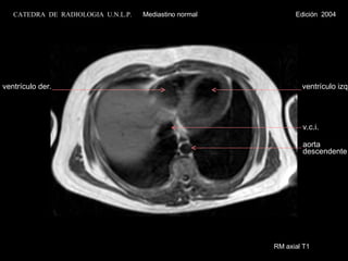 RM axial T1 ventrículo izq. ventrículo der. v.c.i. aorta descendente CATEDRA  DE  RADIOLOGIA  U.N.L.P.   Mediastino normal  Edición  2004 