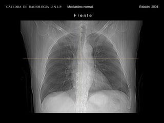 CATEDRA  DE  RADIOLOGIA  U.N.L.P.   Mediastino normal  Edición  2004 F r e n t e 