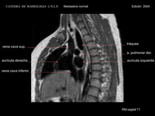 RM sagital T1 aurícula derecha vena cava inferior vena cava sup. aurícula izquierda a. pulmonar der. tráquea CATEDRA  DE  RADIOLOGIA  U.N.L.P.   Mediastino normal  Edición  2004 