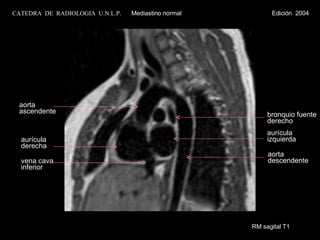 RM sagital T1 bronquio fuente derecho aurícula izquierda aorta ascendente aurícula  derecha vena cava inferior aorta descendente CATEDRA  DE  RADIOLOGIA  U.N.L.P.   Mediastino normal  Edición  2004 