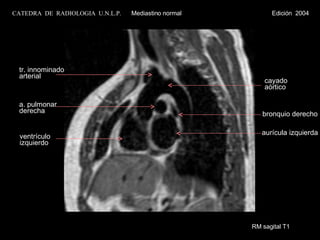 RM sagital T1 ventrículo izquierdo aurícula izquierda cayado  aórtico a. pulmonar  derecha bronquio derecho tr. innominado arterial CATEDRA  DE  RADIOLOGIA  U.N.L.P.   Mediastino normal  Edición  2004 