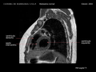 RM sagital T1 ventrículo  izquierdo ventrículo derecho septo  interventric. CATEDRA  DE  RADIOLOGIA  U.N.L.P.   Mediastino normal  Edición  2004 
