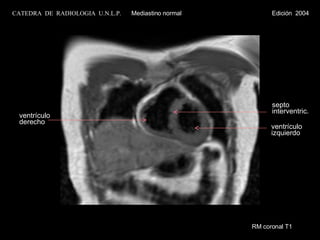 RM coronal T1 ventrículo izquierdo septo  interventric. ventrículo  derecho CATEDRA  DE  RADIOLOGIA  U.N.L.P.   Mediastino normal  Edición  2004 