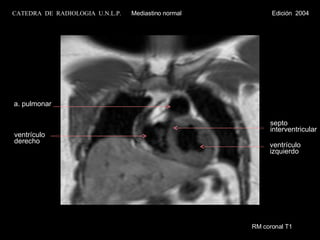 RM coronal T1 ventrículo izquierdo septo  interventricular ventrículo derecho a. pulmonar CATEDRA  DE  RADIOLOGIA  U.N.L.P.   Mediastino normal  Edición  2004 