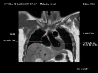 RM coronal T1 ventrículo izq. (tracto de salida) a. pulmonar aurícula der. aorta CATEDRA  DE  RADIOLOGIA  U.N.L.P.   Mediastino normal  Edición  2004 