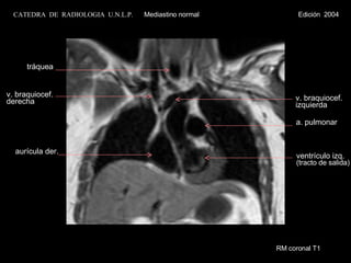 RM coronal T1 aurícula der. a. pulmonar ventrículo izq. (tracto de salida) v. braquiocef. derecha v. braquiocef. izquierda tráquea CATEDRA  DE  RADIOLOGIA  U.N.L.P.   Mediastino normal  Edición  2004 