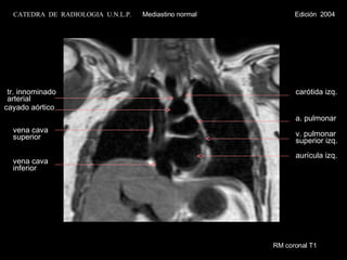 RM coronal T1 vena cava inferior vena cava superior cayado aórtico carótida izq. tr. innominado  arterial aurícula izq. v. pulmonar  superior izq. a. pulmonar CATEDRA  DE  RADIOLOGIA  U.N.L.P.   Mediastino normal  Edición  2004 