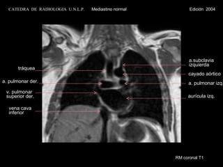 RM coronal T1 vena cava inferior v. pulmonar superior der. a. pulmonar der. tráquea a. pulmonar izq. aurícula izq. a.subclavia  izquierda cayado aórtico CATEDRA  DE  RADIOLOGIA  U.N.L.P.   Mediastino normal  Edición  2004 