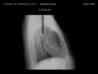 L a t e r a l traquea CATEDRA  DE  RADIOLOGIA  U.N.L.P.   Mediastino normal  Edición  2004 