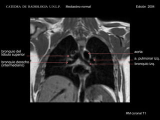 bronquio izq. a. pulmonar izq. bronquio del lóbulo superior aorta bronquio derecho (intermediario) RM coronal T1 CATEDRA  DE  RADIOLOGIA  U.N.L.P.   Mediastino normal  Edición  2004 