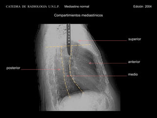 Compartimientos mediastínicos traquea CATEDRA  DE  RADIOLOGIA  U.N.L.P.   Mediastino normal  Edición  2004 anterior medio superior posterior 
