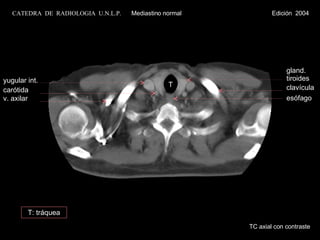 yugular int. carótida  v. axilar gland. tiroides T clavícula esófago TC axial con contraste CATEDRA  DE  RADIOLOGIA  U.N.L.P.   Mediastino normal  Edición  2004 T: tráquea 