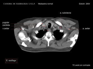 T yugular carótida v.axilar a. subclavia a. axilar E TC axial con contraste E: esófago CATEDRA  DE  RADIOLOGIA  U.N.L.P.   Mediastino normal  Edición  2004 