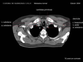 v. braquiocef. T a. subclavia v. subclavia v. axilar clavícula E a. subclavia TC axial con contraste CATEDRA  DE  RADIOLOGIA  U.N.L.P.   Mediastino normal  Edición  2004 carótidas primitivas 