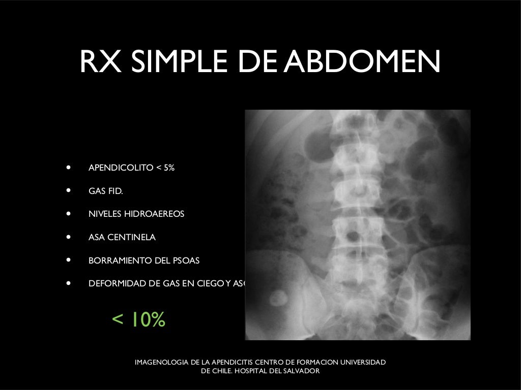 Imagenes en apendicitis ppt