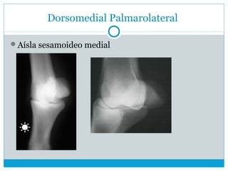 Dorsomedial Palmarolateral
Aísla sesamoideo medial
 