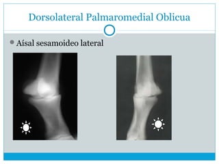 Dorsolateral Palmaromedial Oblicua
Aísal sesamoideo lateral
 