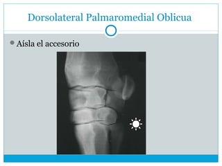 Dorsolateral Palmaromedial Oblicua
Aísla el accesorio
 