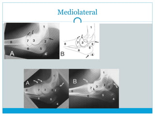 Mediolateral
 