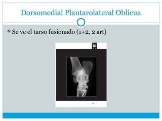 Dorsomedial Plantarolateral Oblicua
Se ve el tarso fusionado (1+2, 2 art)
 