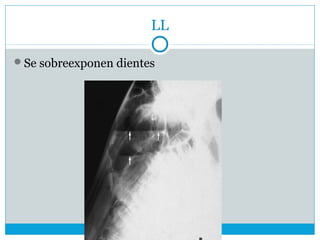 LL
Se sobreexponen dientes
 