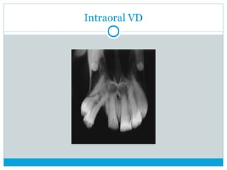 Intraoral VD
 