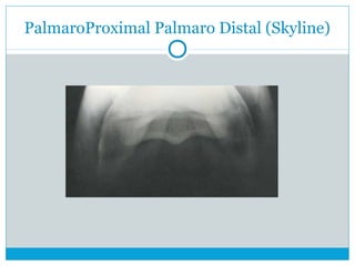 PalmaroProximal Palmaro Distal (Skyline)
 
