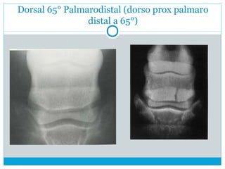 Dorsal 65° Palmarodistal (dorso prox palmaro
distal a 65°)
 