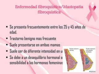 Enfermedad fibroquistica/Mastopatia
fibroquistica
• Se presenta frecuentemente entre los 25 y 45 años de
edad.
• Trastorno benigno mas frecuente
• Suele presentarse en ambas mamas
• Suele ser de diferente intensidad en una que en otra
• Se debe a un desequilibrio hormonal o a un aumento de
sensibilidad a las hormonas femeninas  estrógenos

 