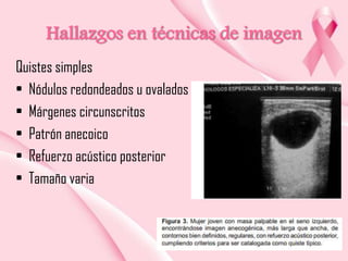 Hallazgos en técnicas de imagen
Quistes simples
• Nódulos redondeados u ovalados
• Márgenes circunscritos
• Patrón anecoico
• Refuerzo acústico posterior
• Tamaño varia

 