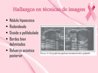 Hallazgos en técnicas de imagen
•
•
•
•

Nódulo hipoecoico
Redondeado
Ovoide o polilobulado
Bordes bien
delimitados
• Refuerzo acústico
posterior

 